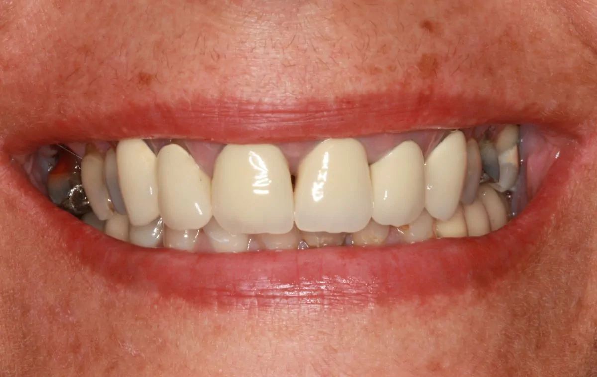 Patient Smile with Metal-Ceramic Crowns Before Replacement