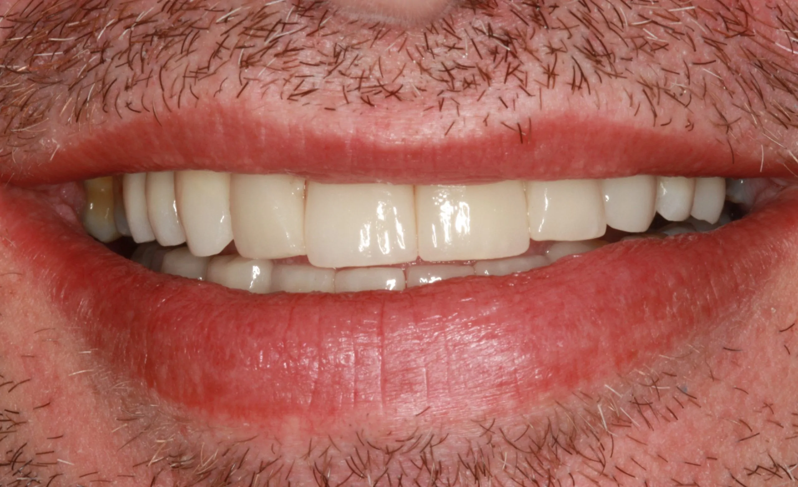 Full Mouth Rehabilitation in a Patient with Multiple Missing Teeth and Loss of Vertical Dimension – after Treatment