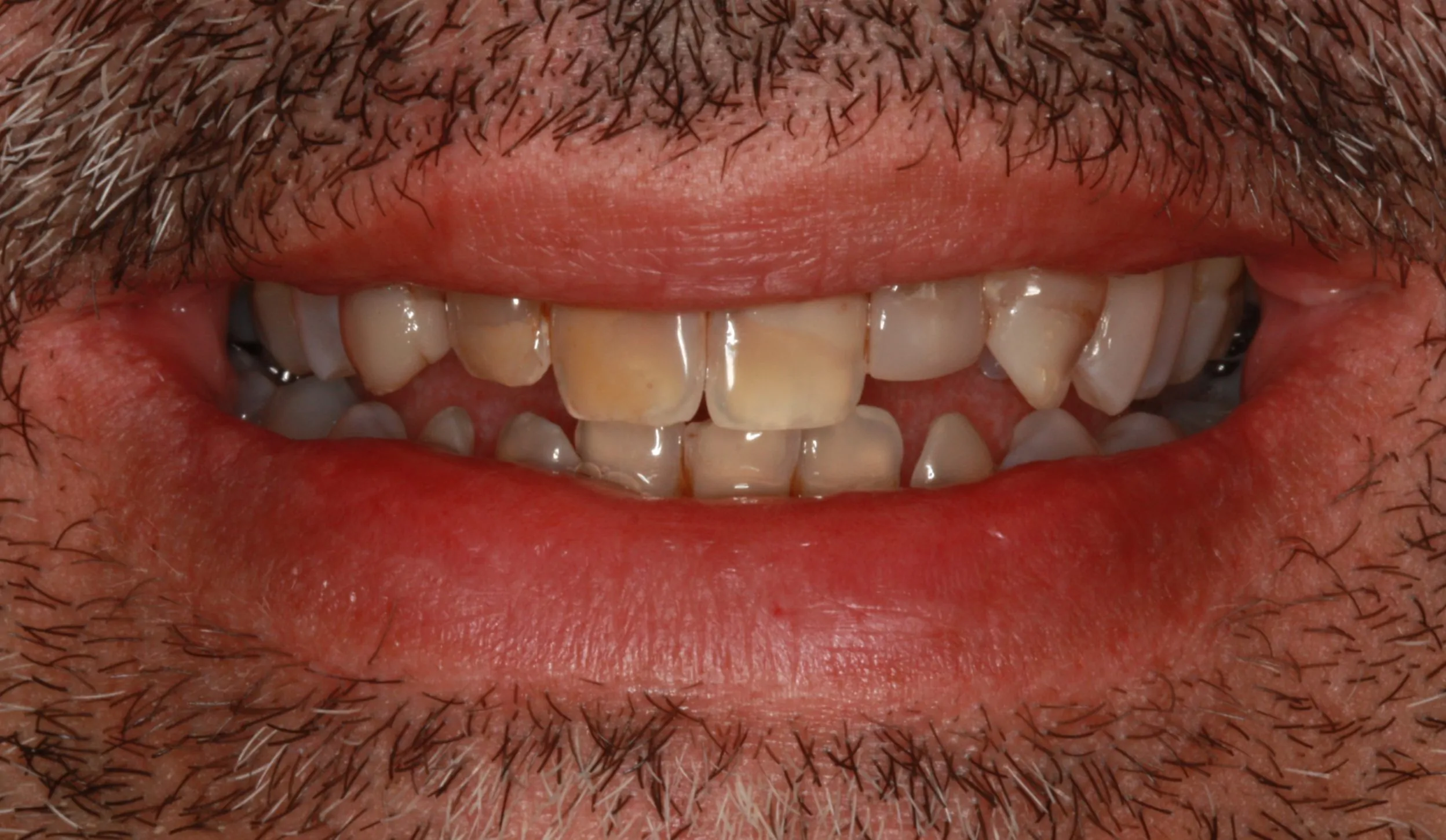 Patient Smile Before Porcelain Veneer Treatment