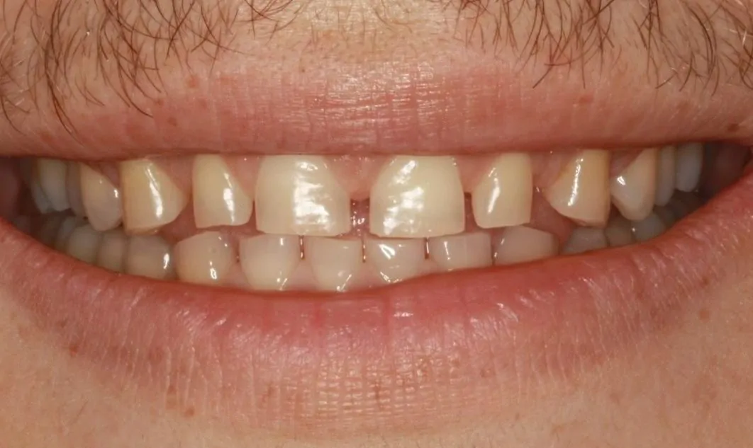 Patient Smile with Gaps Before Composite Veneer Treatment