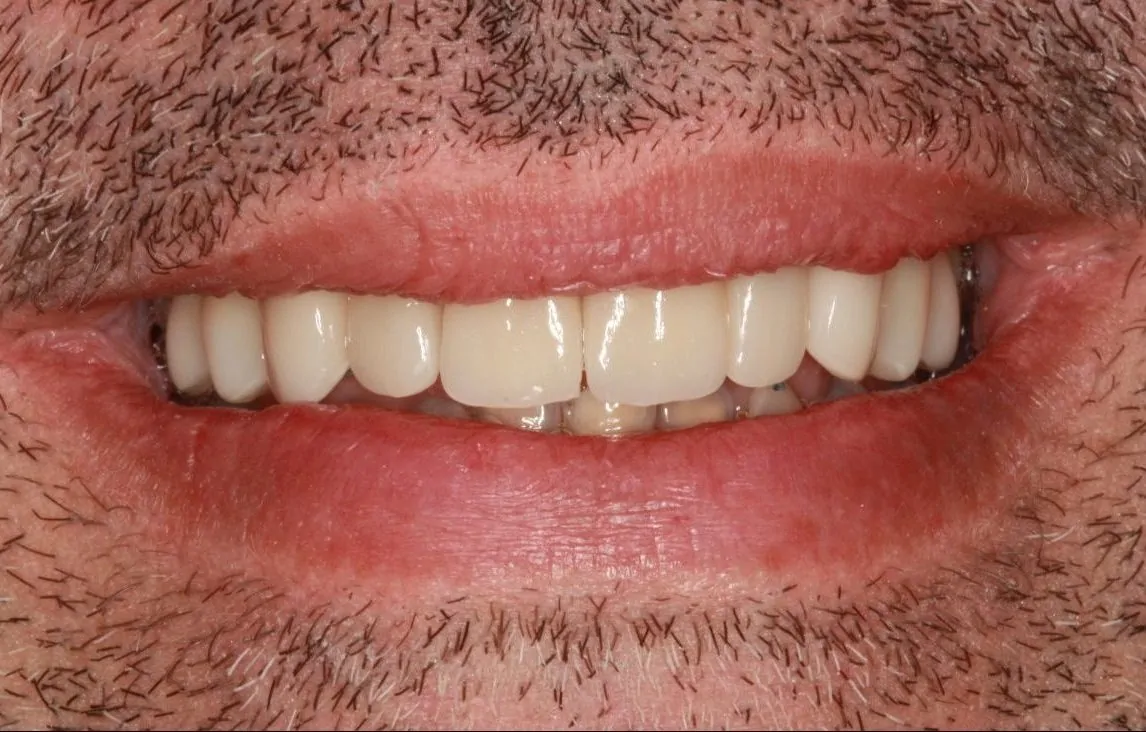 Patient Smile After Porcelain Veneer Treatment
