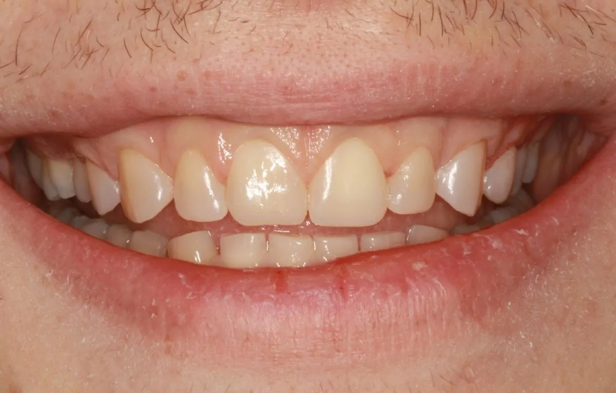 Patient Smile After Composite Veneer Treatment
