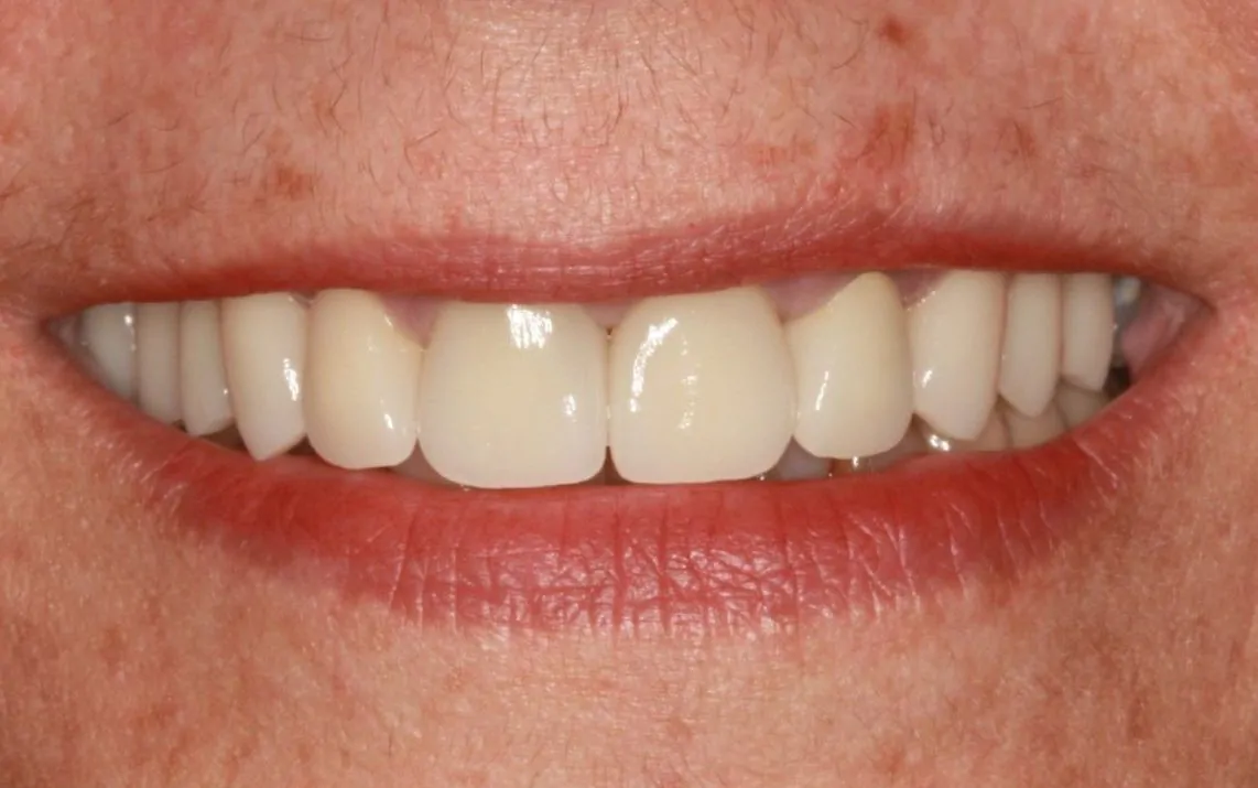 Patient Smile with All-Ceramic Crowns After Digital Smile Design