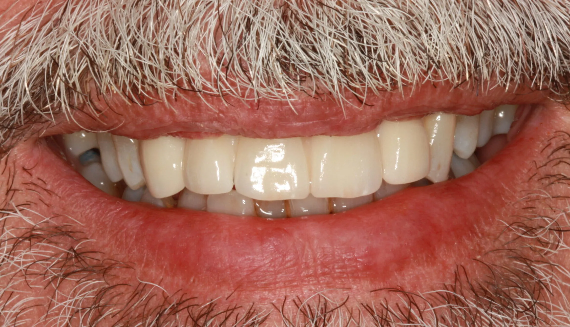Periodontal Patient after Dental Implant Treatment