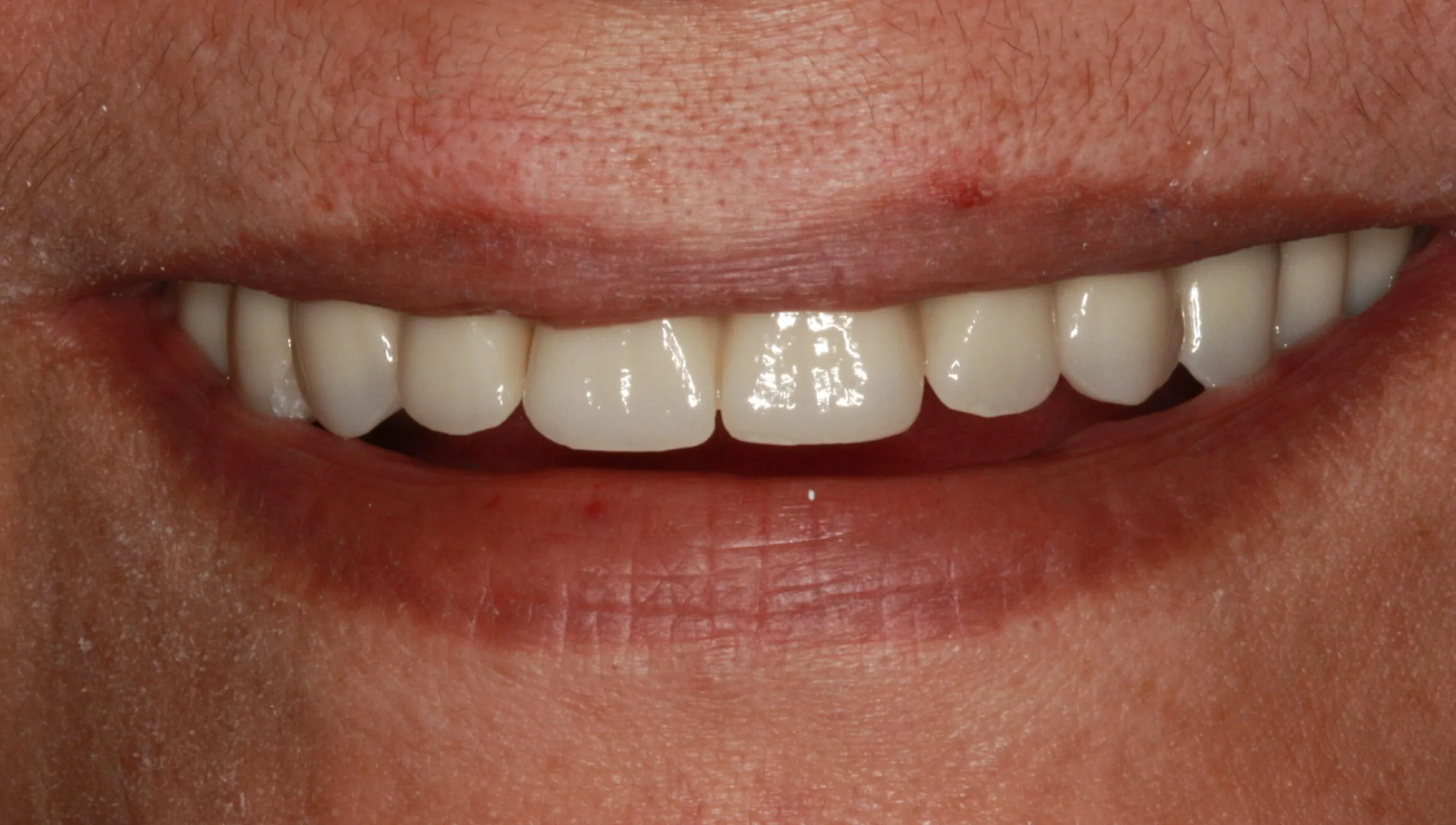 Periodontal Patient after Dental Implant Treatment