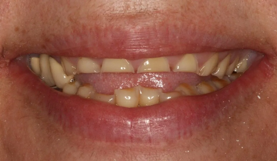 Tooth Erosion Before Minimally Invasive Prosthodontics | DentArtistry