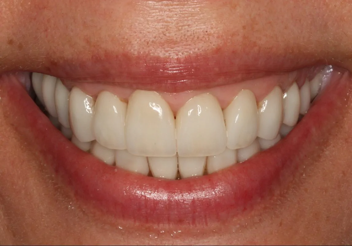 Dental Erosion Treatment After Minimally Invasive Prosthodontics | DentArtistry
