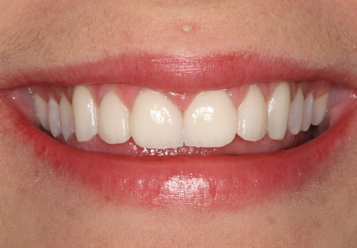 Patient Smile with Porcelain Veneers | DentArtistry