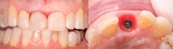 προσωρινή στεφάνη και επούλωση περιεμφυετυματικών ιστών σε περιστατικό άμεσης φόρτισης